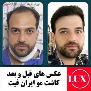 عکس های قبل و بعد از کاشت مو در کلینیک ایران فیت